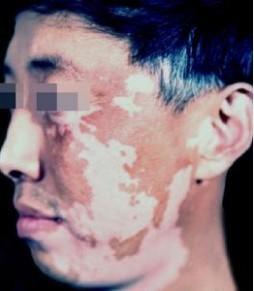 汕头白癜风是什么引起的,首推广州皮肤病研治中心