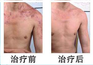 东莞湿疹治疗与预防,十佳名院,广州皮肤病研治中心